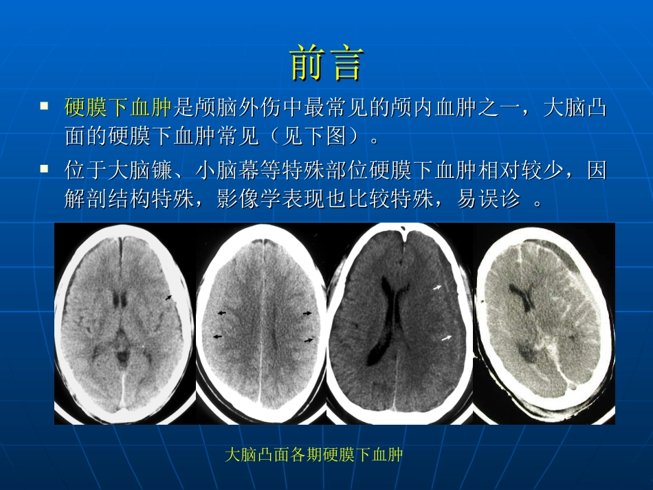 小脑幕硬膜下血肿_第2页