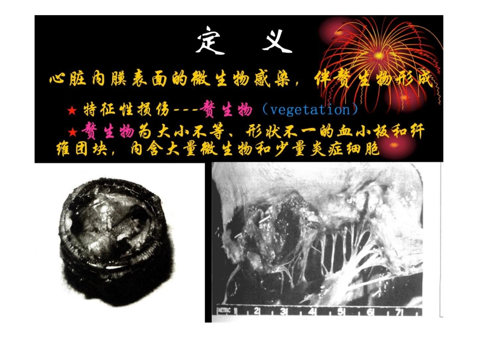 感染性心内膜炎(2)_第2页