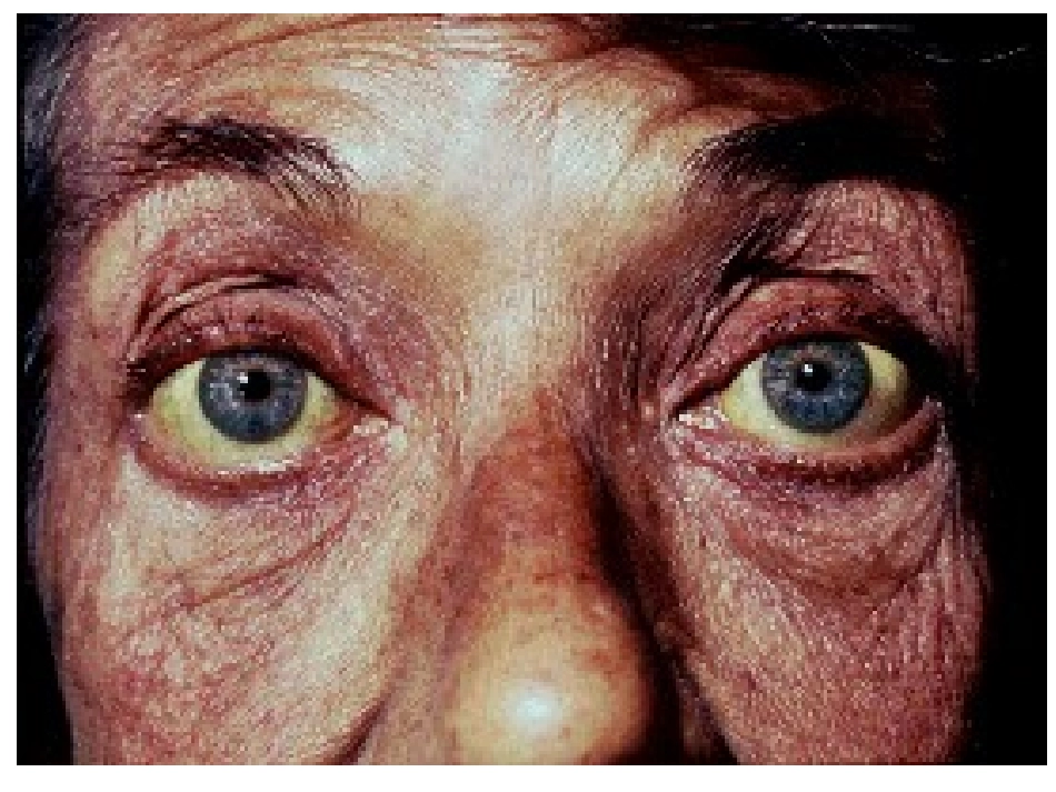 肝硬化(图)_第2页