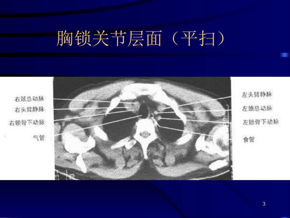 正常胸部CT_第3页