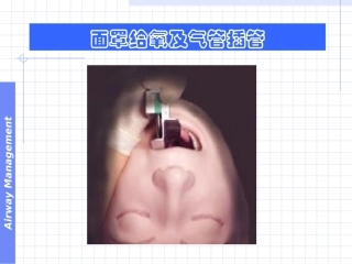 呼吸气囊和气管插管