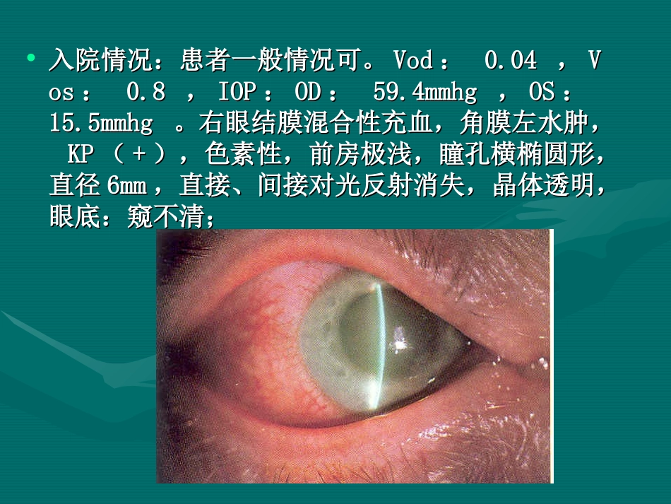 glaucoma示教-孙传宾_第3页
