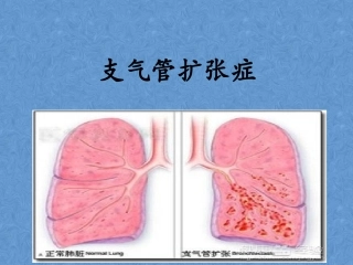 支气管扩张2018