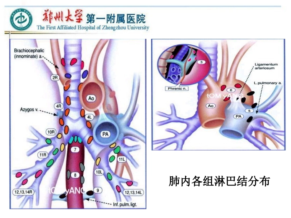 VATS左侧肺癌根治术中的淋巴结清扫---胸外科_第1页