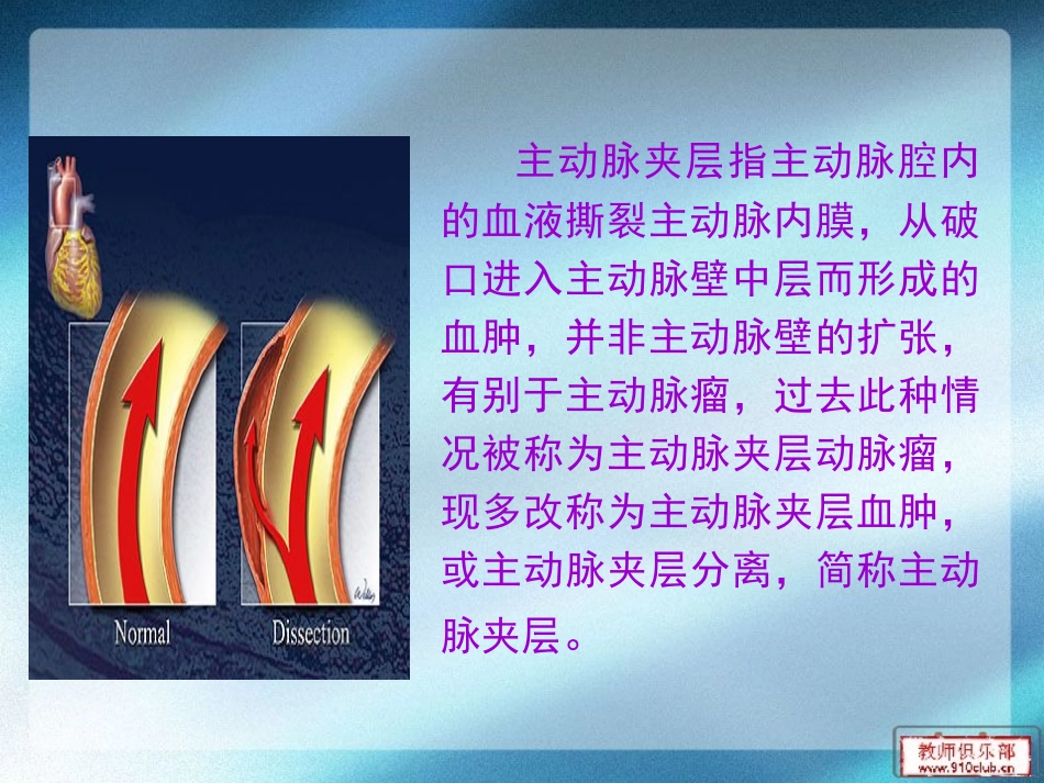 主动脉夹层的诊治_第2页