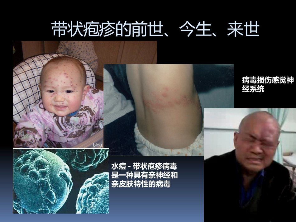 带状疱疹及后遗神经痛科普_第2页