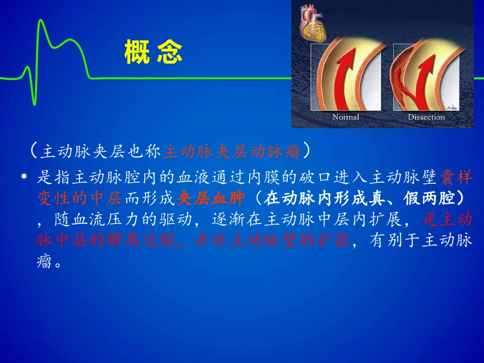 主动脉夹层(修改版)_第3页