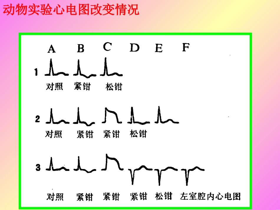急性心肌梗死心电图演变_第3页