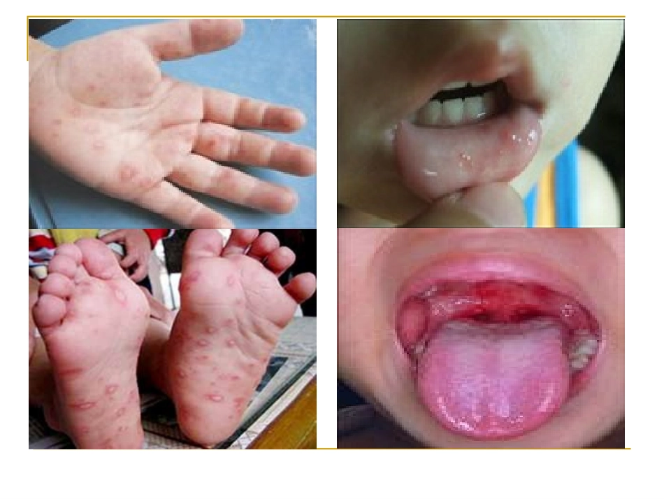 手足口病的预防与治疗_第3页