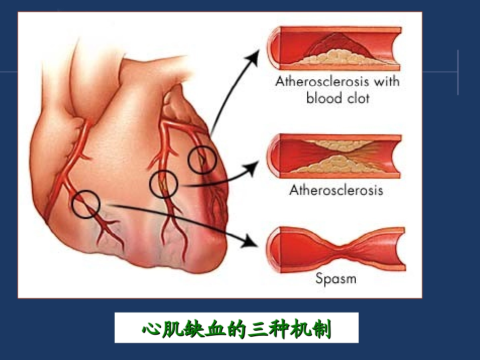 西药综合-第十章-冠状动脉粥样硬化性心脏病_第3页