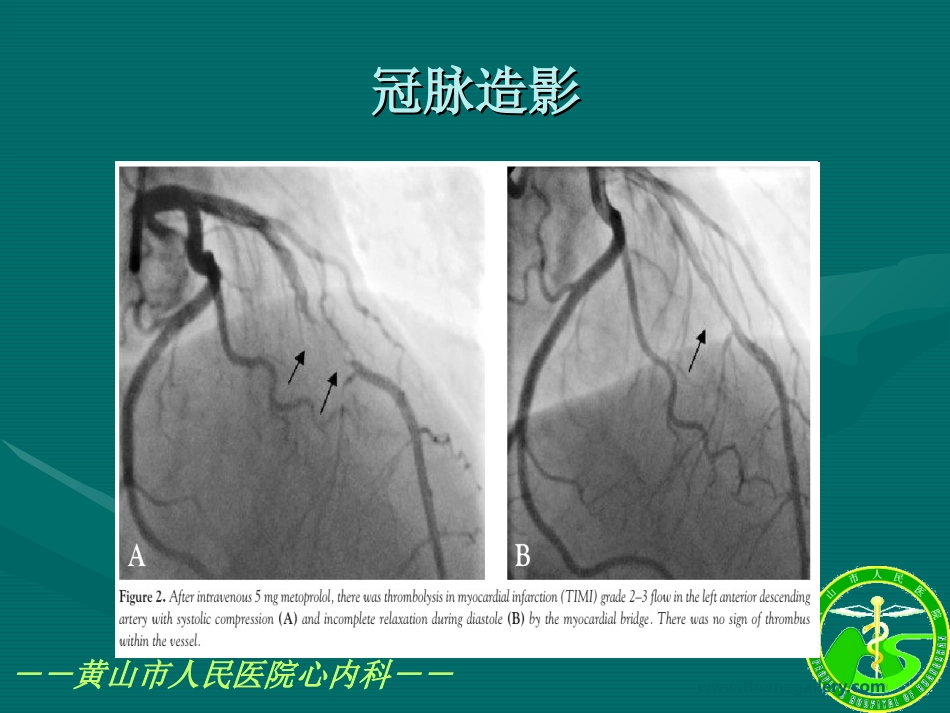 血管痉挛性心绞痛(变异型心绞痛)分析_第3页