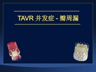 TAVR并发症-瓣周漏