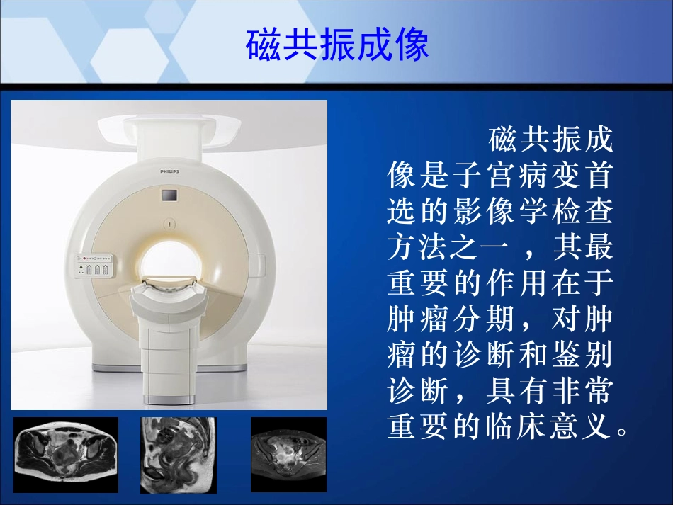 子宫内膜癌的MRI表现_第2页