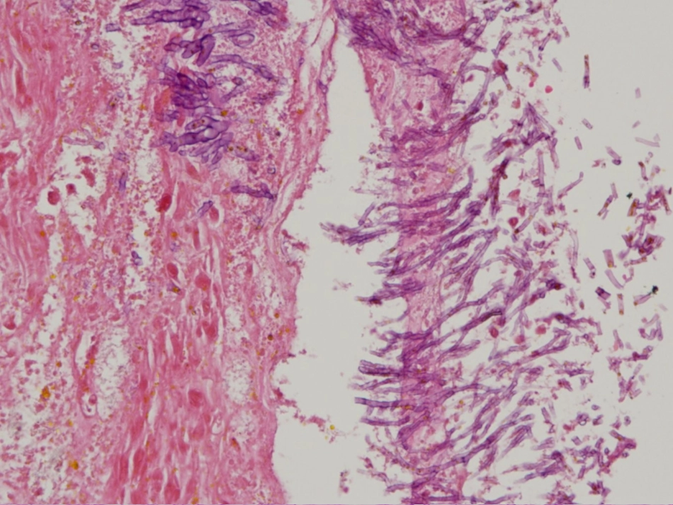 从实践看呼吸科肺部真菌感染(第三军医大学西南医院呼吸科-熊玮)_第3页
