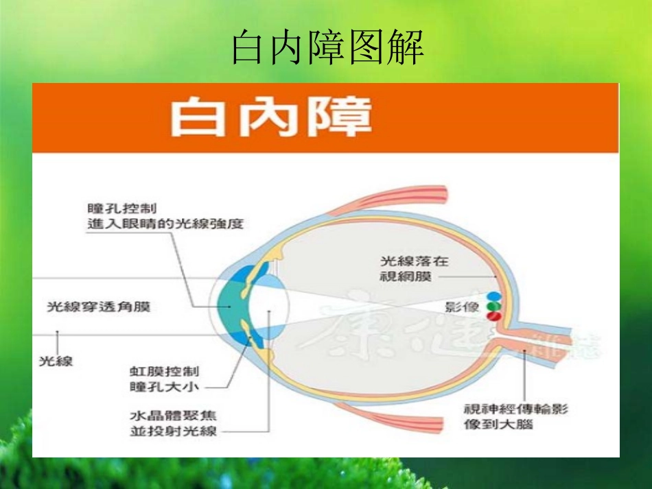 年龄相关性白内障_第2页