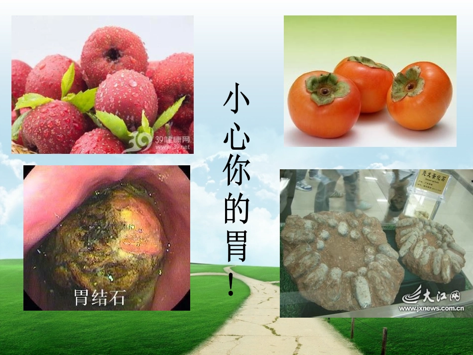 胃石症李付粉4.7.._第2页