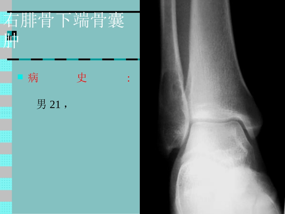 骨肿瘤X线病例图谱_第1页