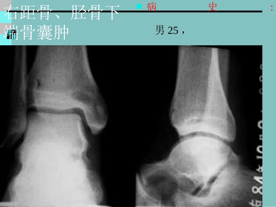 骨肿瘤X线病例图谱_第2页