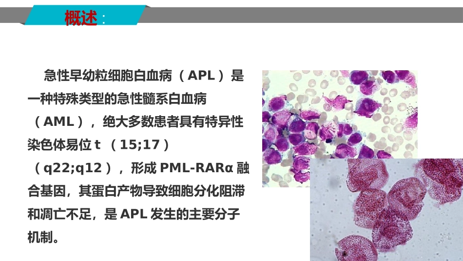 中国2018版急性早幼粒细胞白血病诊疗指南_第2页