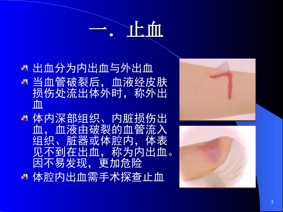 外伤急救止血、固定、转运_第3页