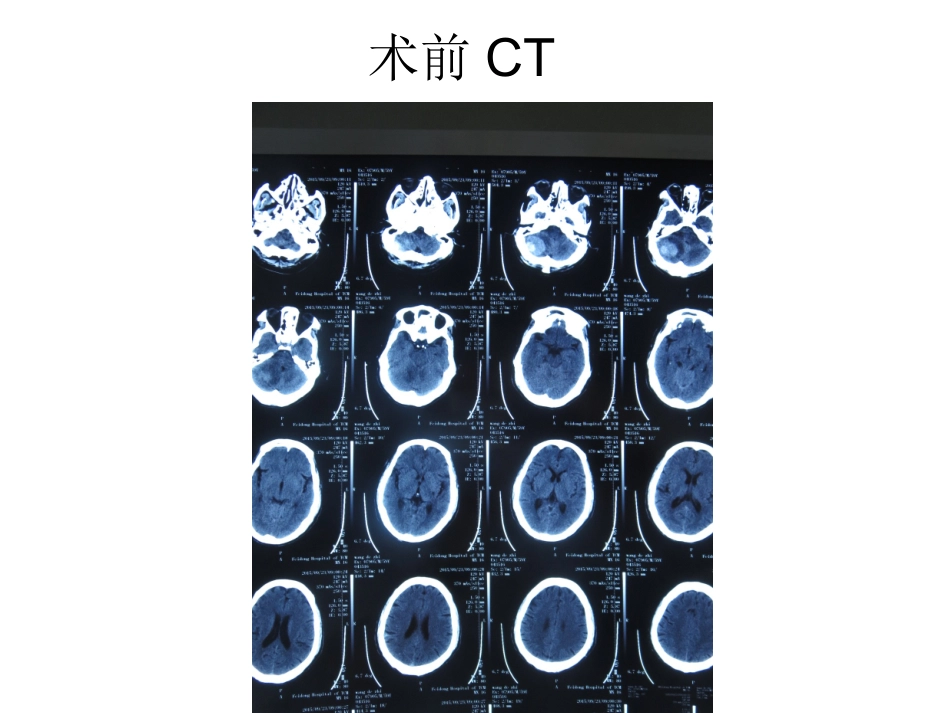 幕下术后发生急性梗阻性脑积水的思考与处理_第3页
