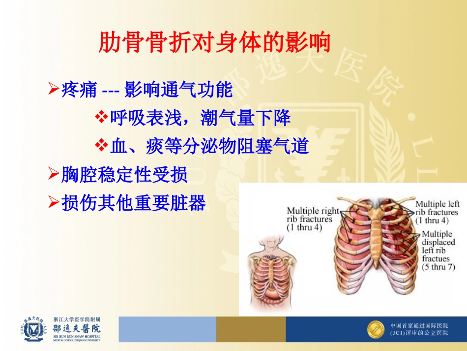 多根肋骨骨折胸腔不稳定型_第2页