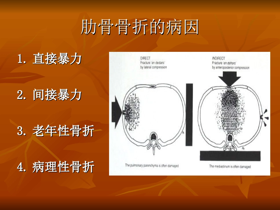 肋骨接骨板的临床应用_第2页
