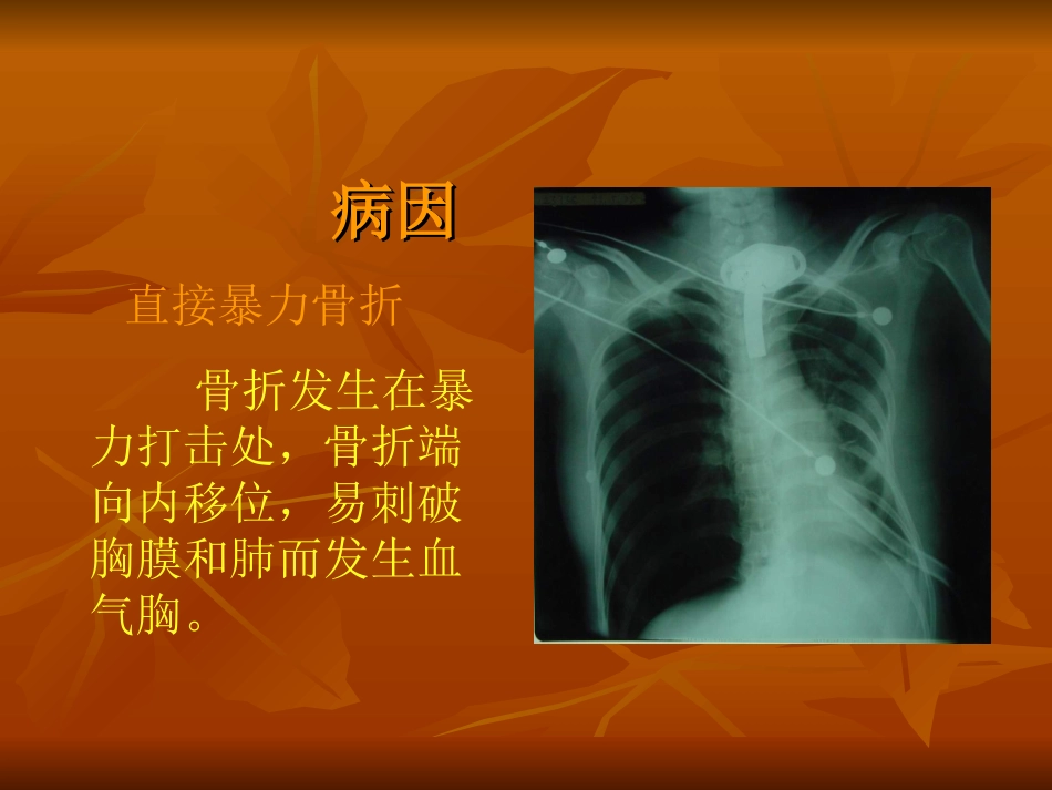 肋骨接骨板的临床应用_第3页