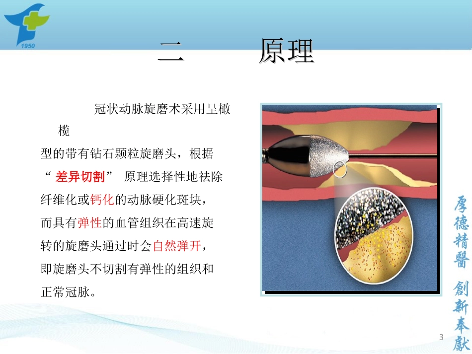冠状动脉旋磨术_第3页