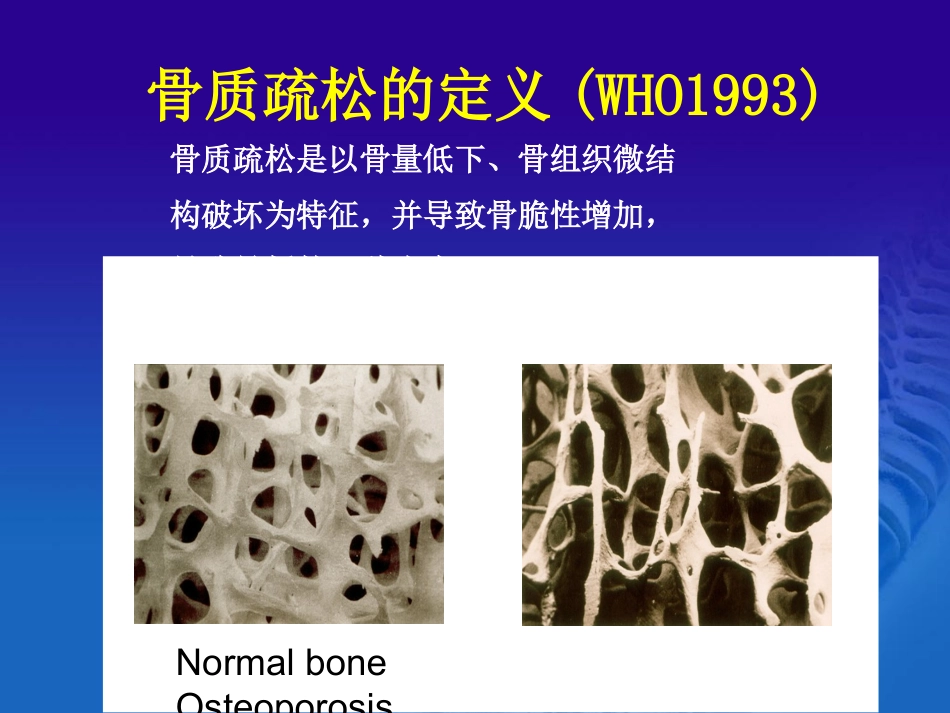 骨质疏松诊治与中医药.ppt_第2页