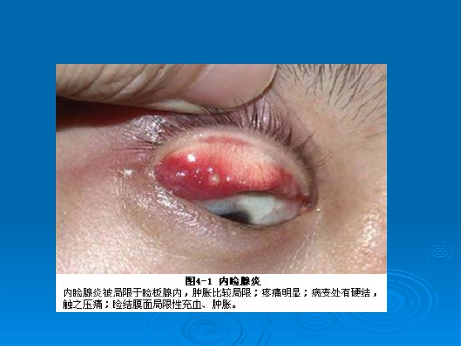 眼睑病与泪器病_第3页