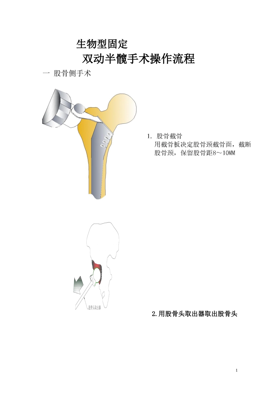 髋关节置换手术操作流程_第1页
