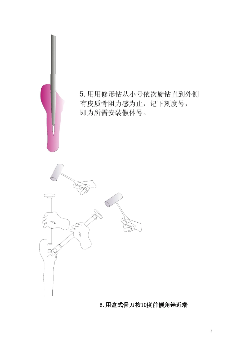 髋关节置换手术操作流程_第3页