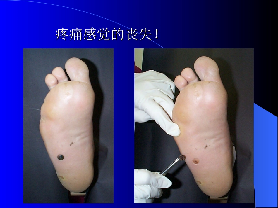 糖尿病足讲座2010-4_第3页