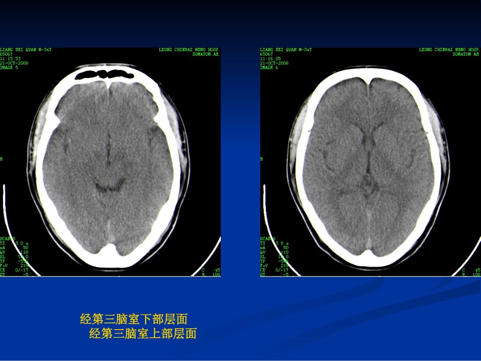 颅脑基本CT征象及颅脑外伤性疾病CT诊断_第3页
