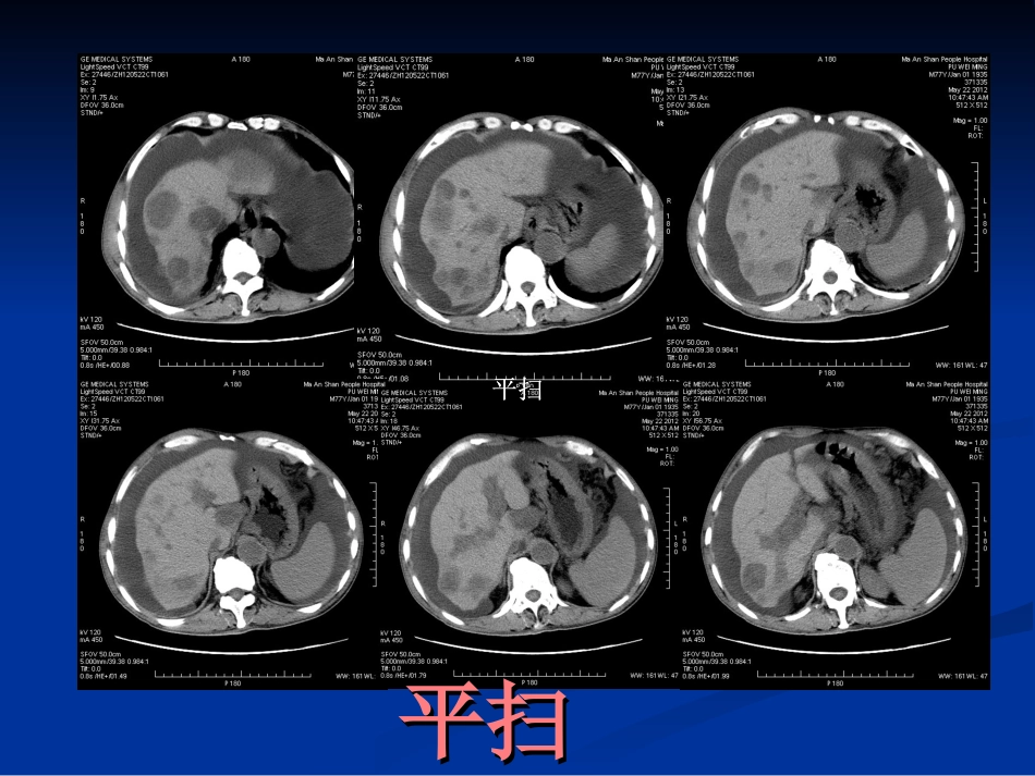 AFP阳性胃癌_第3页
