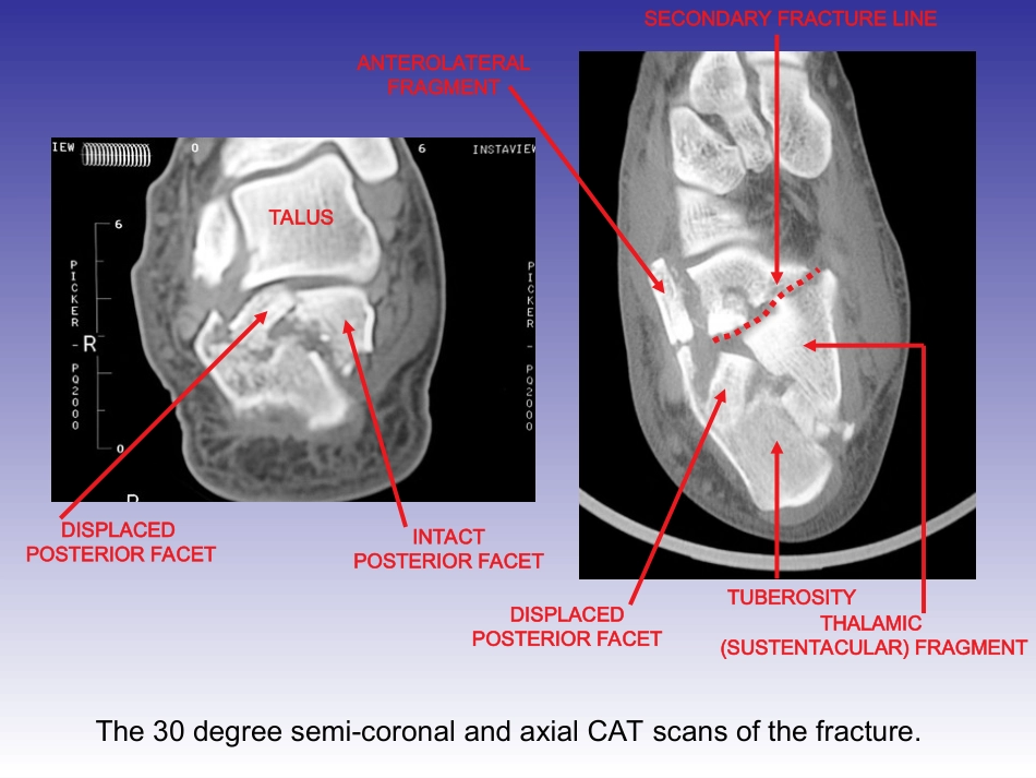 CALCANEU跟骨骨折_第3页