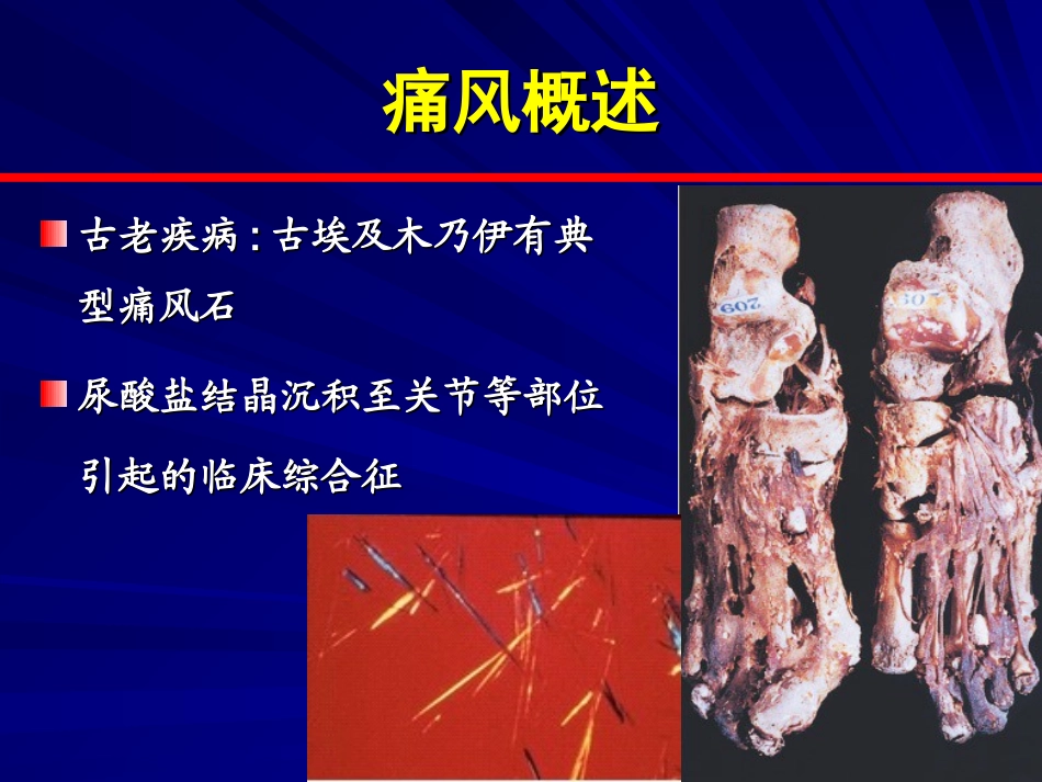 痛风指南解读和诊治进展-2015-5-1_第2页