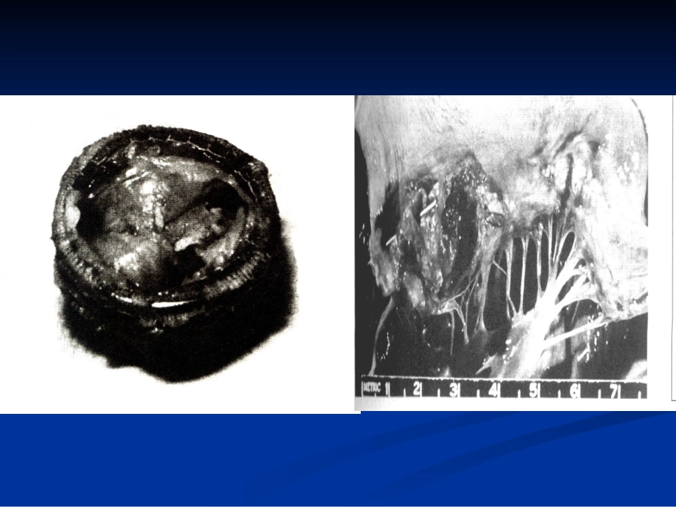 改感染性心内膜炎--于_第3页