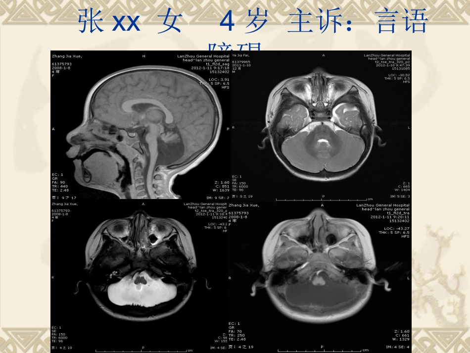 颅脑先天发育畸形两例1_第2页