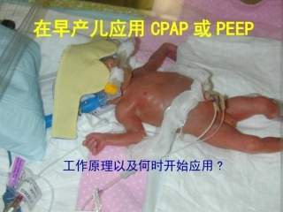 婴幼儿CPAP呼吸机