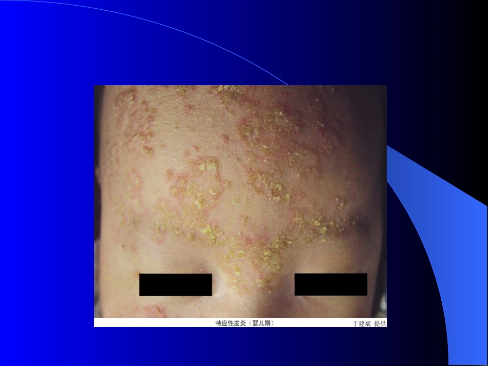 特应皮炎.11_第1页