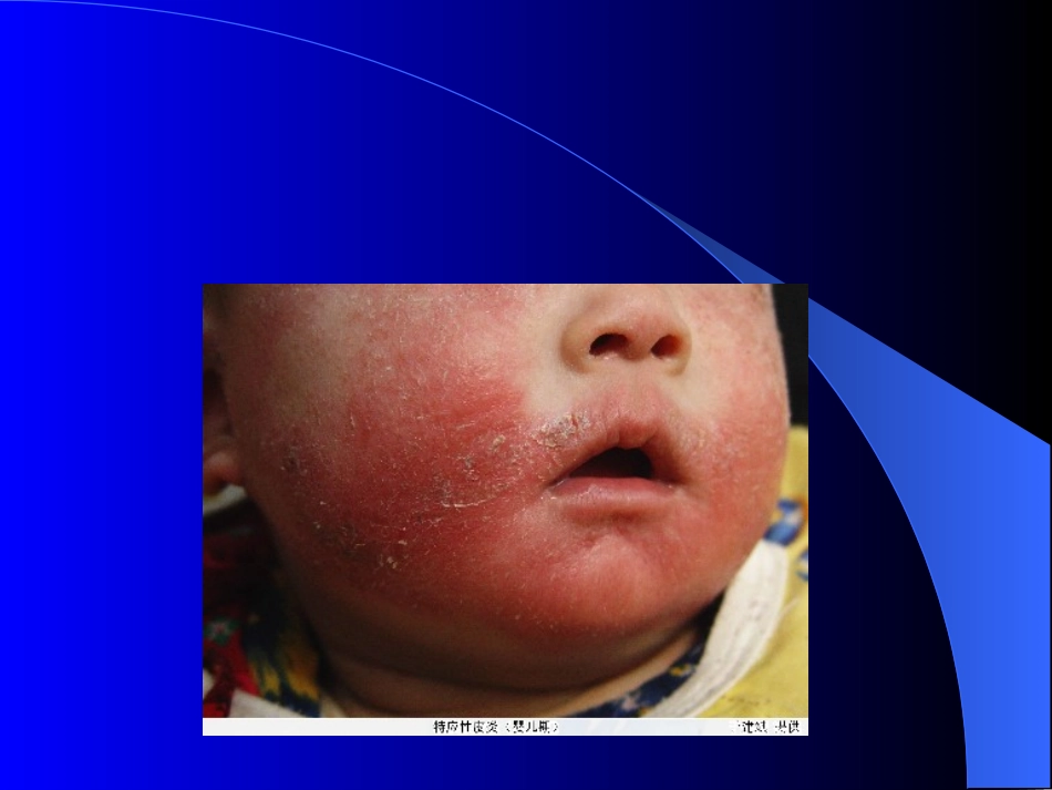 特应皮炎.11_第2页