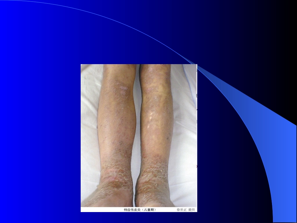 特应皮炎.11_第3页