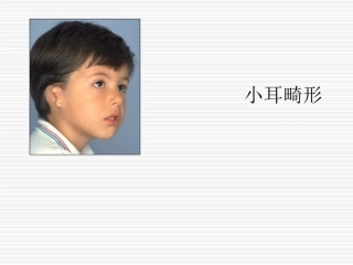 小耳畸形重建