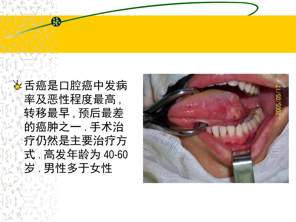 常见三种舌癌手术方式1_第3页