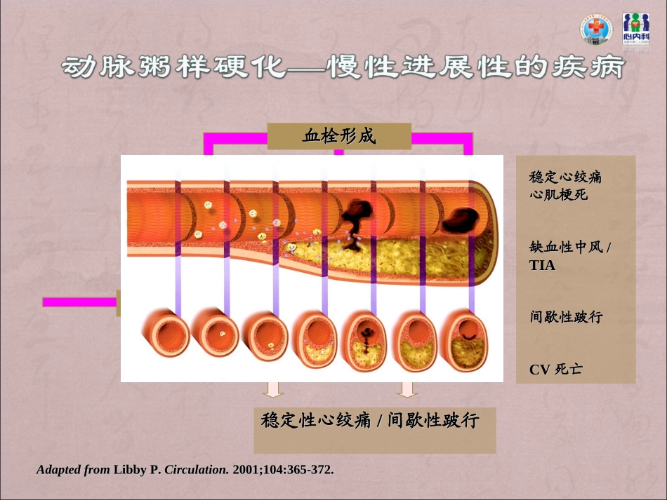降脂与动脉粥样硬化斑块的逆转_第3页