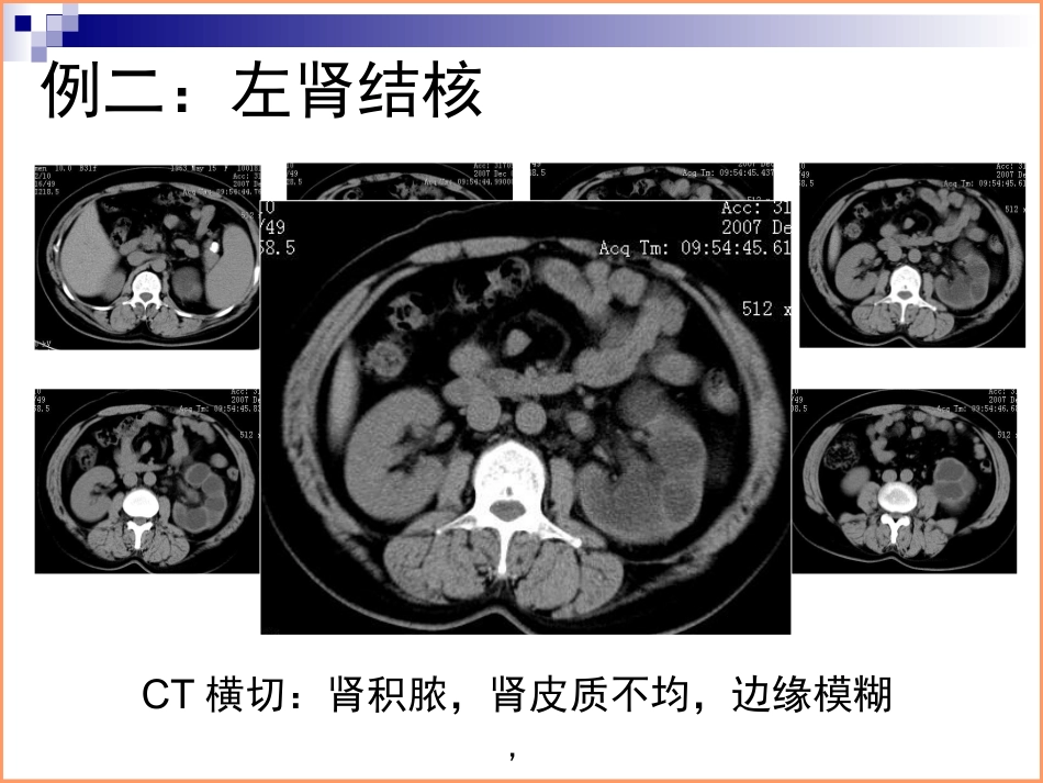 泌尿系结核典型病例影像资料_第3页