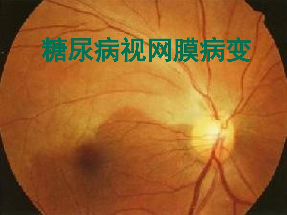 糖尿病视网膜病变1_第1页