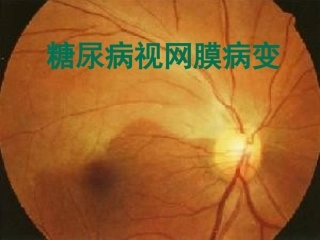 糖尿病视网膜病变1